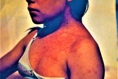 hemangioma-plano-multiple-1982-000