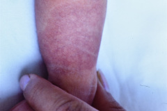 hemangioma-plano-pierna-der-001