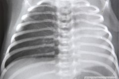 hemangiomatosis-pulmonar-izq-masa-hemitorax-izq-desvio-mediastino-der-postop-tac-1995-001