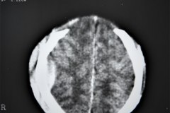hematoma-epidural-tac-1995-000