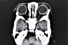 hematoma-epidural-tac-1995-001