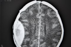 hematoma-epidural-tac-1995-002