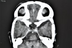hematoma-epidural-tac-1995-003