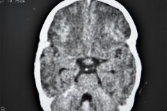 hematoma-epidural-tac-1995-004
