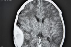hematoma-epidural-tac-1995-005