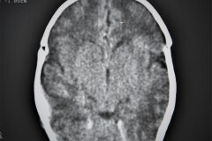 hematoma-epidural-tac-1995-006