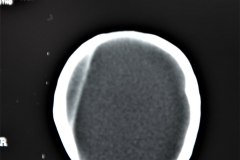 hematoma-epidural-tac-000