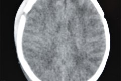 hematoma-subgaleal-frontoparietal-der-1998-000