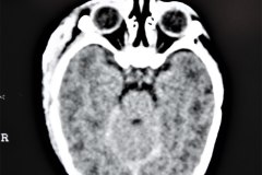 hematoma-subgaleal-frontoparietal-der-1998-002