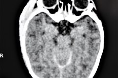 hematoma-subgaleal-frontoparietal-der-1998-003
