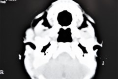hematoma-subgaleal-frontoparietal-der-1998-004