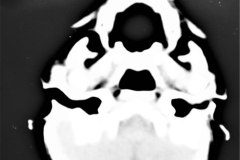 hematoma-subgaleal-frontoparietal-der-1998-005