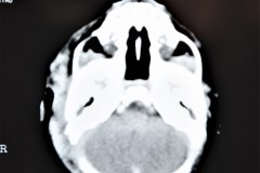 hematoma-subgaleal-frontoparietal-der-1998-006