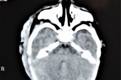 hematoma-subgaleal-frontoparietal-der-1998-007