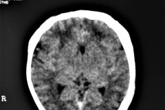 hematoma-subgaleal-frontoprietal-izq-y-occipital-caput-1996-000