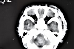 hematoma-subgaleal-frontoprietal-izq-y-occipital-caput-1996-001