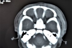 hematoma-subgaleal-frontoprietal-izq-y-occipital-caput-1996-002
