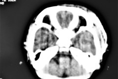 hematoma-subgaleal-frontoprietal-izq-y-occipital-caput-1996-004