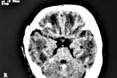 hematoma-subgaleal-frontoprietal-izq-y-occipital-caput-1996-007
