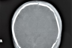 hematoma-subgaleal-frontoprietal-izq-y-occipital-caput-1996-008