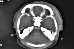 hematoma-subgaleal-frontoprietal-izq-y-occipital-caput-1996-009