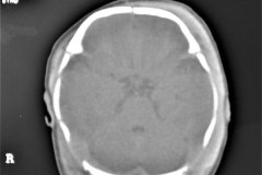 hematoma-subgaleal-frontoprietal-izq-y-occipital-caput-1996-011