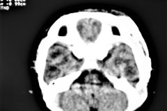 hematoma-subgaleal-frontoprietal-izq-y-occipital-caput-1996-012