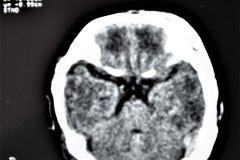 hematoma-subgaleal-frontoprietal-izq-y-occipital-caput-1996-013