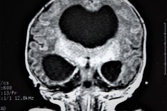 hematoma-subgaleal-hidrocefalia-tac-rnm-1998-000