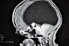 hematoma-subgaleal-hidrocefalia-tac-rnm-1998-001