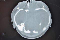 hematoma-subgaleal-hidrocefalia-tac-rnm-1998-002