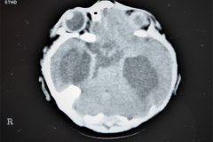 hematoma-subgaleal-hidrocefalia-tac-rnm-1998-003