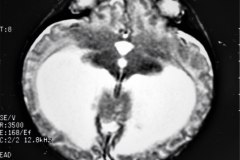 hematoma-subgaleal-hidrocefalia-tac-rnm-1998-004