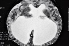 hematoma-subgaleal-hidrocefalia-tac-rnm-1998-005
