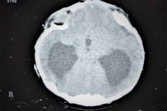 hematoma-subgaleal-hidrocefalia-tac-rnm-1998-006