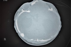 hematoma-subgaleal-hidrocefalia-tac-rnm-1998-007
