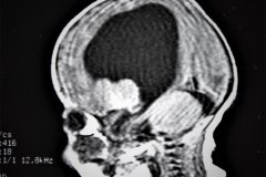 hematoma-subgaleal-hidrocefalia-tac-rnm-1998-008