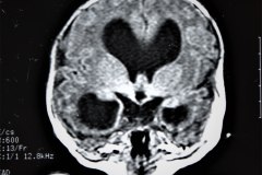 hematoma-subgaleal-hidrocefalia-tac-rnm-1998-009