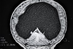 hematoma-subgaleal-hidrocefalia-tac-rnm-1998-010