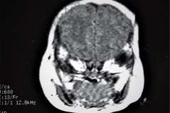 hematoma-subgaleal-hidrocefalia-tac-rnm-1998-011