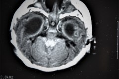 hematoma-subgaleal-hidrocefalia-tac-rnm-1998-012