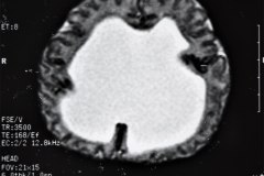 hematoma-subgaleal-hidrocefalia-tac-rnm-1998-013