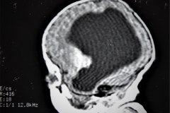 hematoma-subgaleal-hidrocefalia-tac-rnm-1998-014