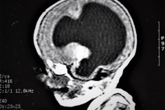hematoma-subgaleal-hidrocefalia-tac-rnm-1998-015