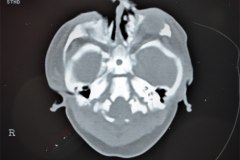 hematoma-subgaleal-hidrocefalia-tac-rnm-1998-016