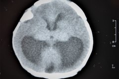hematoma-subgaleal-hidrocefalia-tac-rnm-1998-017
