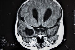 hematoma-subgaleal-hidrocefalia-tac-rnm-1998-018