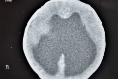hematoma-subgaleal-hidrocefalia-tac-rnm-1998-019