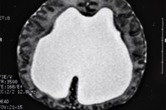 hematoma-subgaleal-hidrocefalia-tac-rnm-1998-020