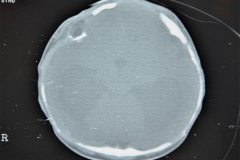 hematoma-subgaleal-hidrocefalia-tac-rnm-1998-021